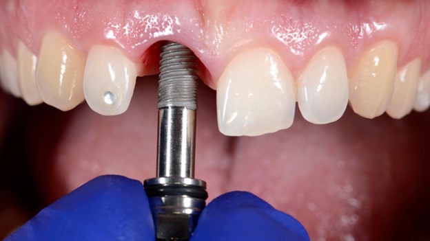 Image of a person with a dental implant in their mouth. learn dental implant cost as well.